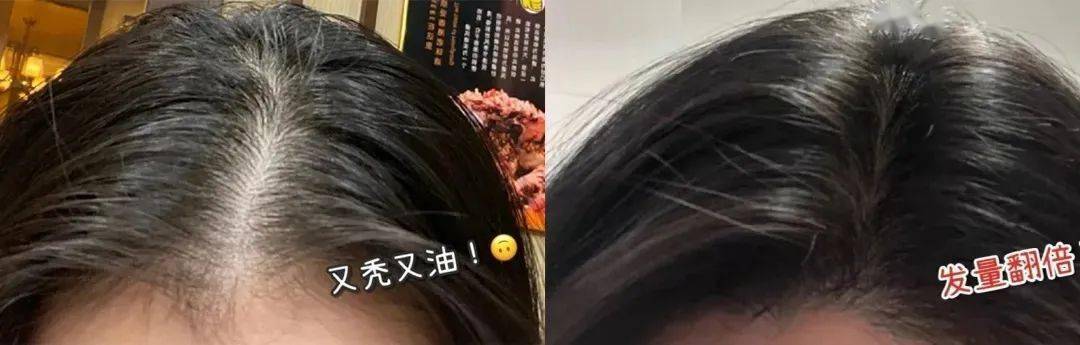 尸体头上抠下来的白泥竟是螨虫尸体!头痒头屑出油多,用它就对了