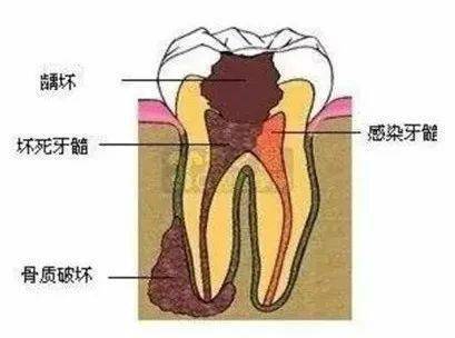 怎么才能让牙神经不疼 4113cb8d7b9c4ab1b22ed822355ba262.jpeg