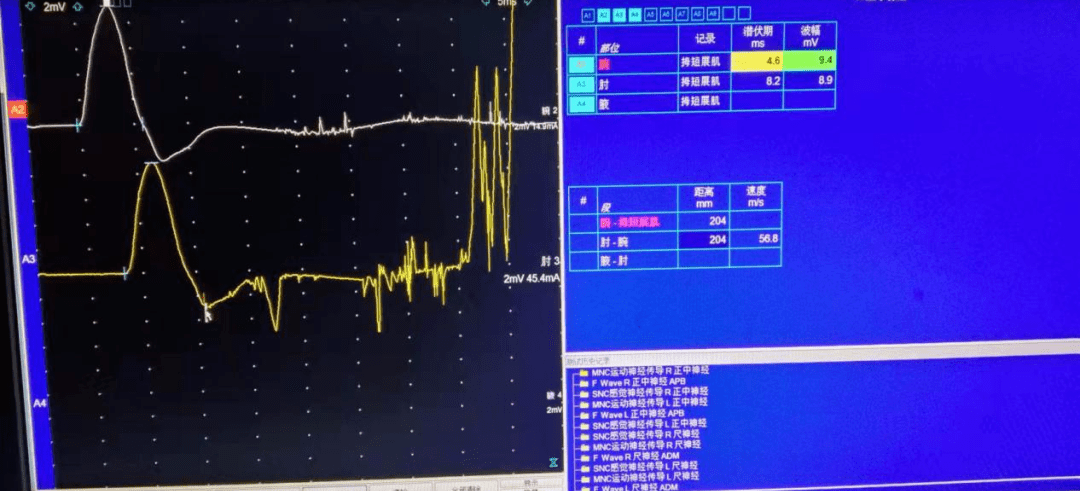 手麻勿忽视肌电图的检查腕管综合征