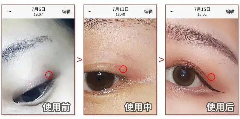 医学长了脂肪粒到底挤不挤?一分钟教你处理它的正确姿势!