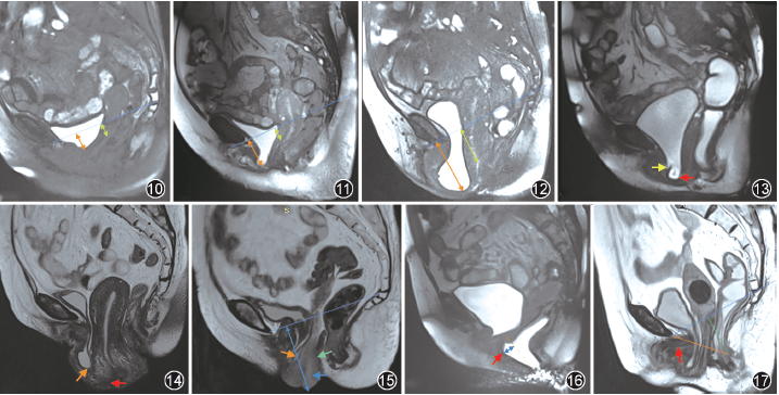 图10~12不同程度盆腔器官脱垂mri.