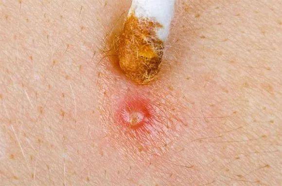 什么叫毛囊性丘疹 724d9a4ce2e7426cae8c25d30ac2023d.jpeg