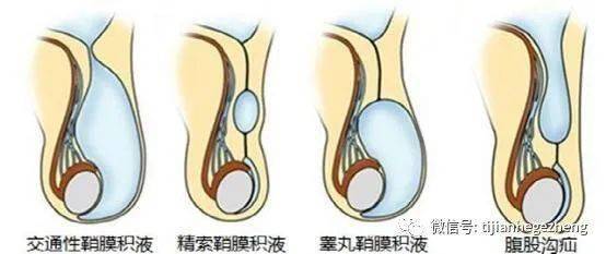 招飛體檢常見異常:鞘膜積液_睪丸_陰囊_其他