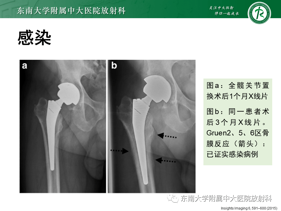 77pg/ml;降钙素原:0.