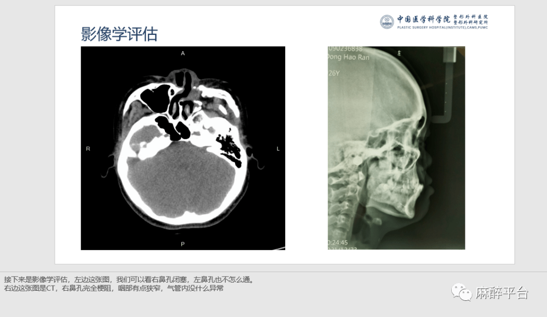 右边这张图是ct,右鼻孔完全梗阻,咽部有点狭窄,气管内没什么异常第四