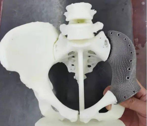 骨外二科成功开展云南省首例个体化3d打印钛合金半骨盆假体精准重建术