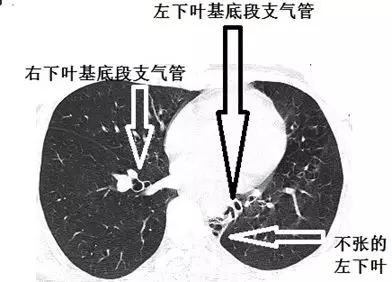 支氣管告密這個肺部ct有問題