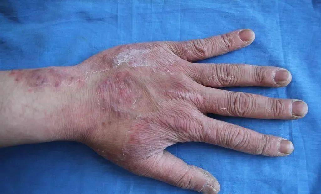 手癣属于皮肤真菌感染性疾病,多数是由于足癣继发感染所致