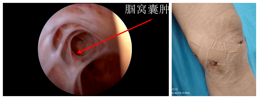 腘窝手术切口图片