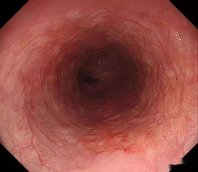 早期食管癌真实图片图片