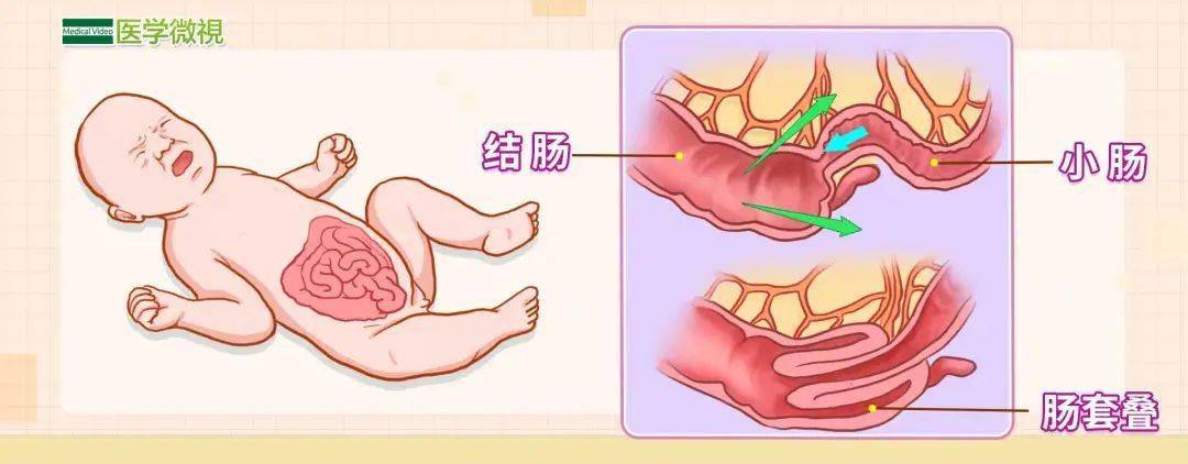 小孩肠梗阻图片