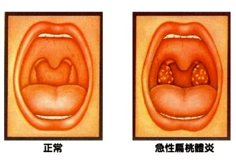 儿童扁桃体炎,家长知多少?孩子经常"感冒","哭闹",不是孩子的错!