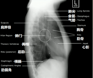 小儿肺炎x线胸片图解图片