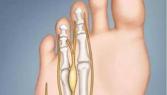 趾甲|身体有问题，脚会告诉你！脚部出现9种症状，很危险，别拖