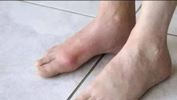 趾甲|身体有问题，脚会告诉你！脚部出现9种症状，很危险，别拖