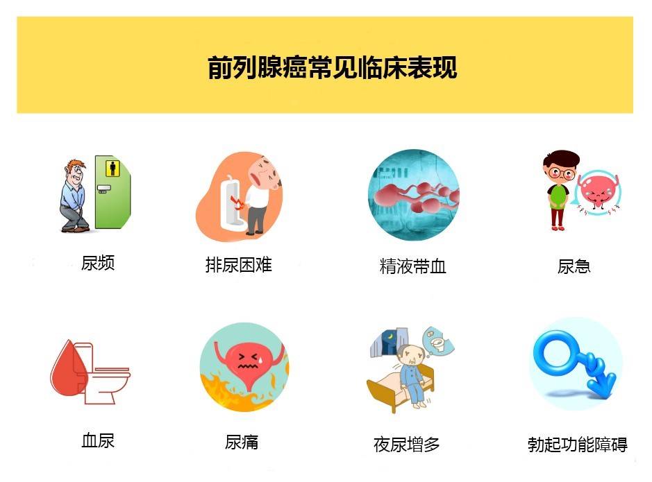 出现这些症状需警惕前列腺癌