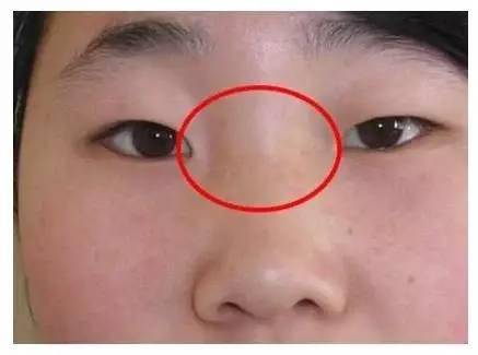 鼻梁_鼻子_婚姻