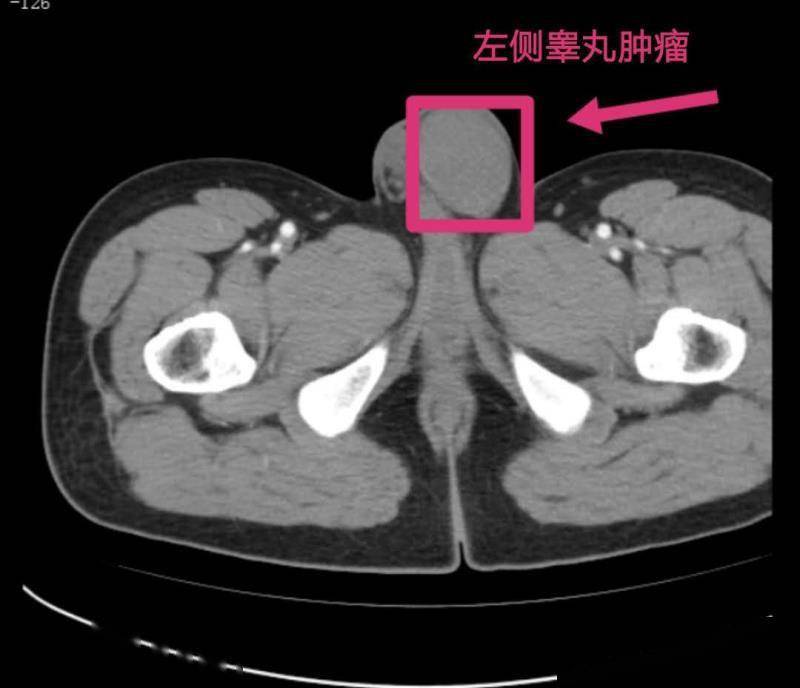 阴囊癌症状图片大全图片