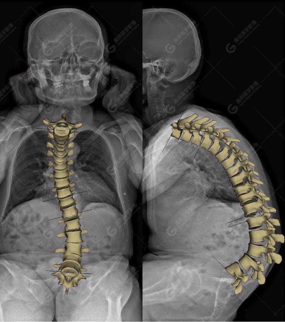 小伙驼背20余年,eos成像下,脊柱竟成"c"型_情况_评估_患者