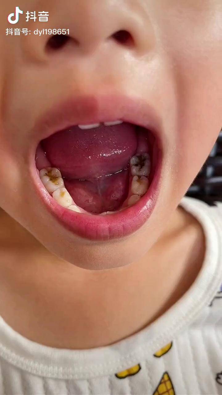 小孩子虫牙照片图片