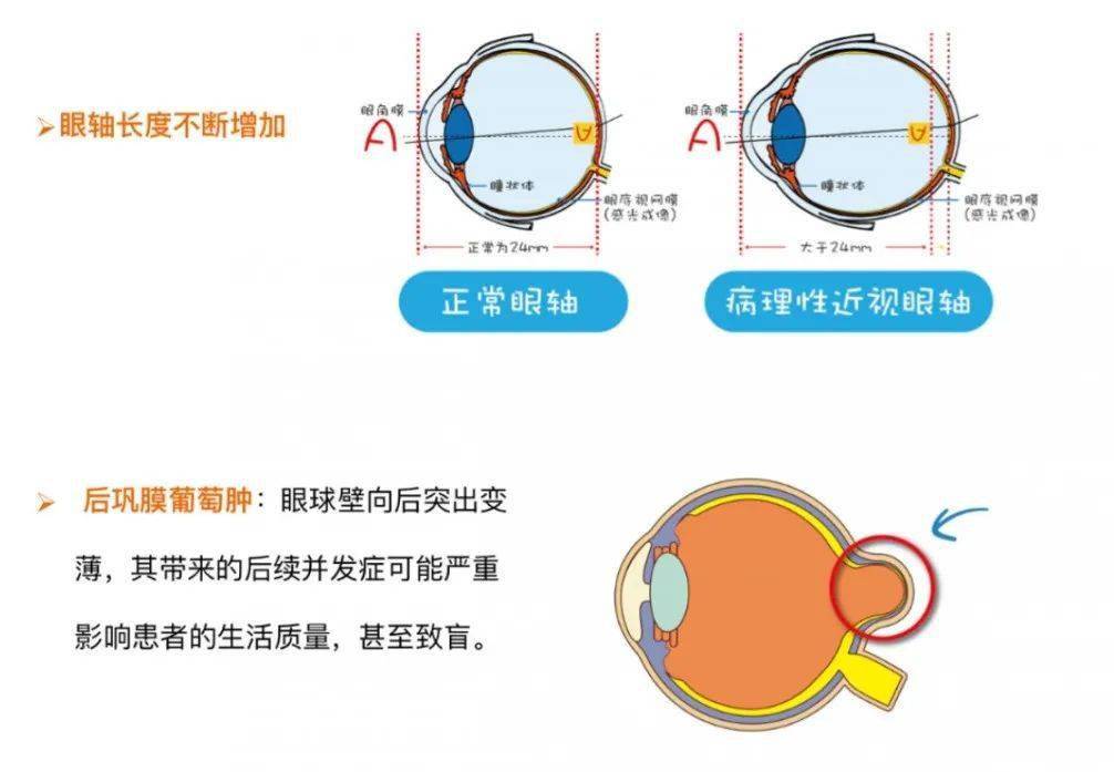 隨著近視度數的增加,眼軸不斷被拉長,視網膜和脈絡膜可發生變薄等異常