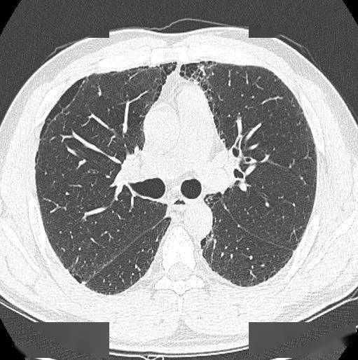 胸部|这个间质性肺炎，还挺少见的