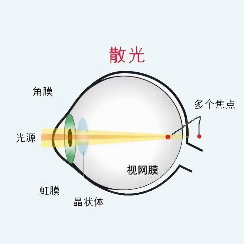 視力篩查報告單怎麼看