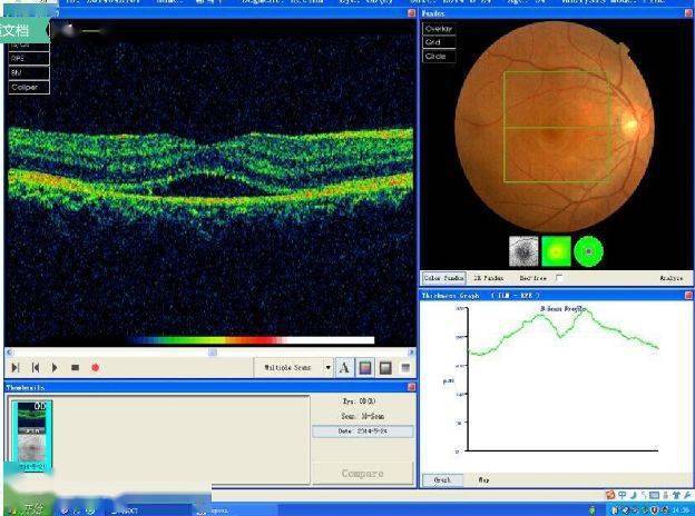 眼科oct报告单图片