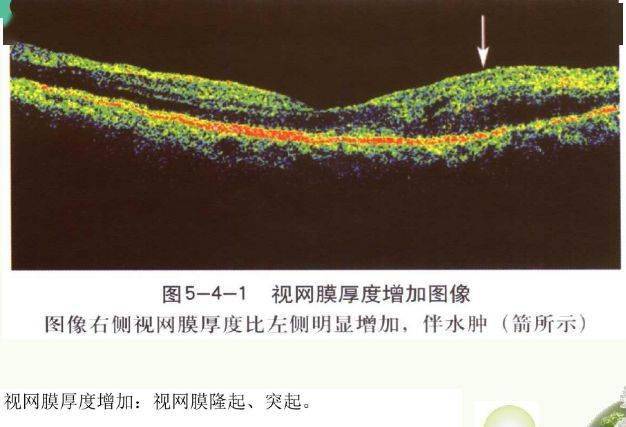 眼科新手必备oct基础知识
