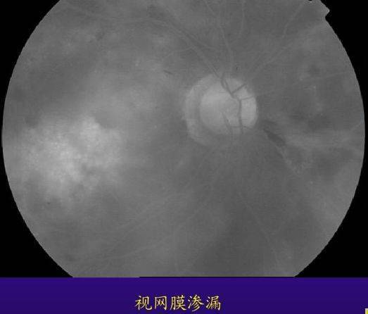 荧光素眼底血管造影术的基础知识