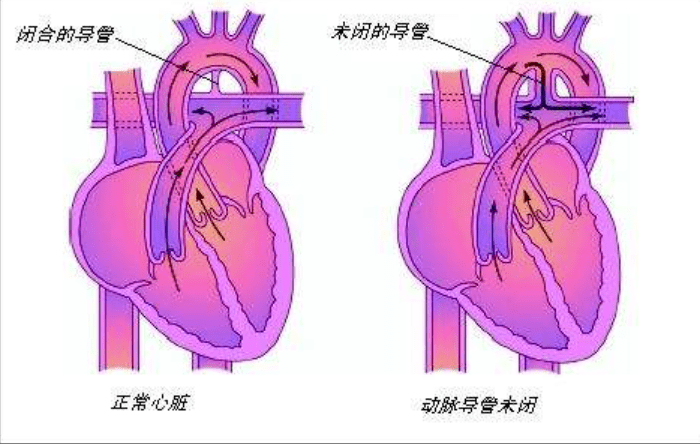 成人先天性心脏病,你知道多少?_肺动脉_患者_艾森曼格