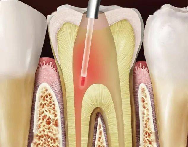 对牙周袋消毒,可以使得对牙周病的治疗多了一个有效的方法;对拔牙