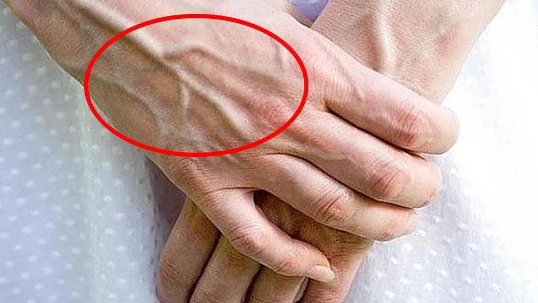 手上青筋越多说明身体越千万不要不当回事