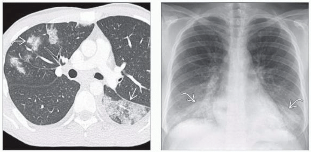 肺炎的早期症状ct图片图片