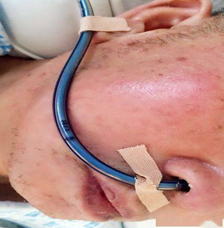 胃管留置,你真的掌握了吗?_患者_长度_临床