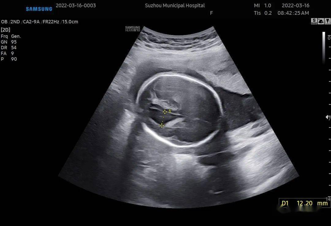 77脊髓圆锥低,骶尾部见一块东西,然而,没有柠檬头,没有香蕉小脑!