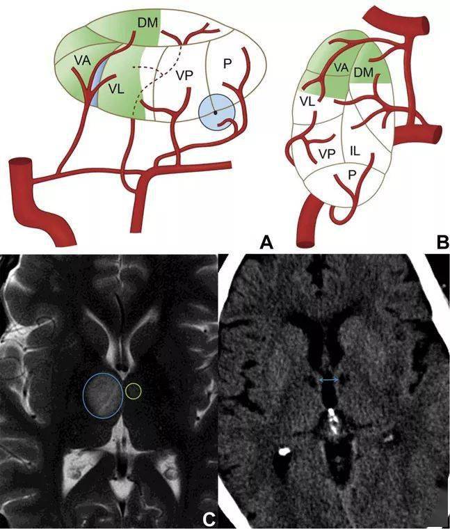 症状|图文并茂：丘脑梗死的临床和影像学特征