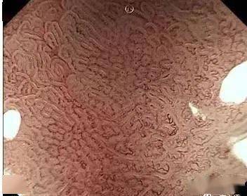 易浸润全胃,使整个胃壁发生硬化而呈皮革样改变,一旦发展到了"皮革胃"