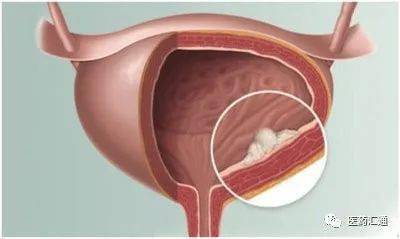 长期染发导致膀胱癌警惕这些高危因素
