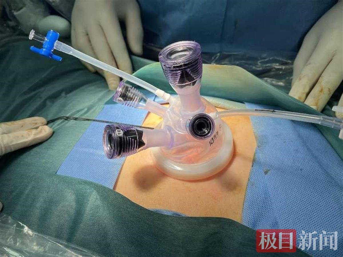 单孔腹腔镜,微创手术的"高精尖"