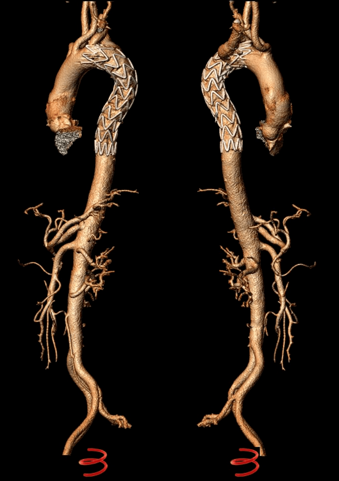西北专栏甘肃省人民医院陈泉教授团队分享了1例主动脉穿透性溃疡并壁