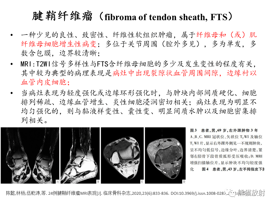 腱鞘鉅細胞瘤你想到了嗎?有收穫嗎?