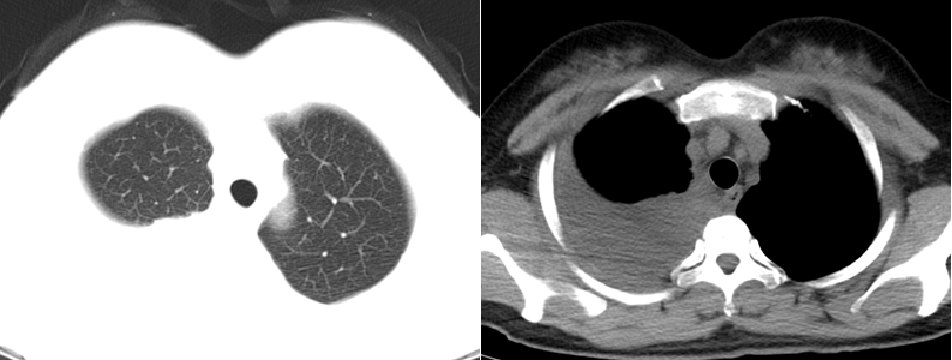 结核性胸膜炎:胸部影像学对结核性胸膜炎仅能发现胸腔积液,单纯从