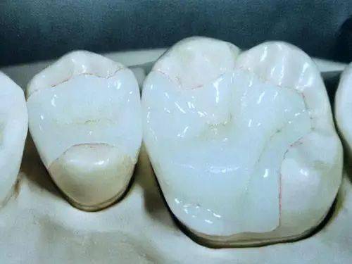 制备全瓷高嵌体,全瓷冠粘结步骤详解!