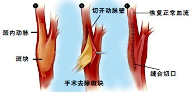 消除颈动脉中沉默杀手山东大学齐鲁医院德州医院脑血管外科完成全市