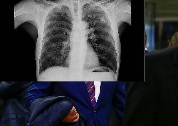 bbc咳嗽不断加发烧不一定是新冠肺炎医生警告可能是肺结核
