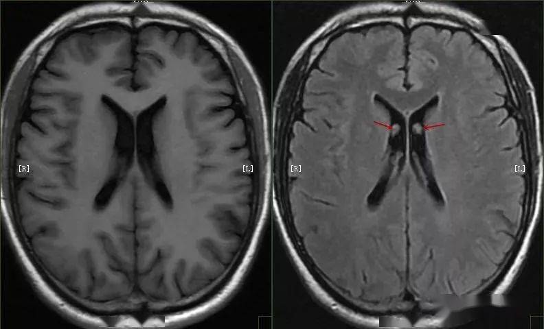 扫盲头颅mri该如何扫描