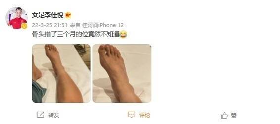 微博|女足国脚李佳悦晒疗伤照：骨头错了三个月的位竟然不知道