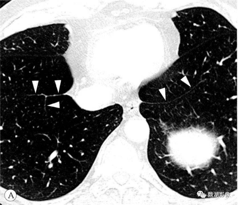 胸部ct上的肺韧带别再报纤维条索了