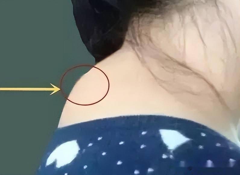 穴位经络养生铲平富贵包关键在于促进颈部气血循环